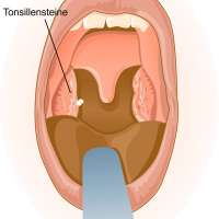 Tonsillensteine behandlung - Tonsillensteine entfernen