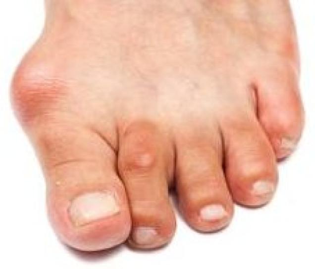 Wer kennt den Hallux valgus?