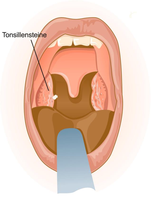 Tonsillensteine behandlung - Tonsillensteine entfernen