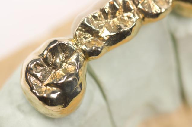 Goldpreisexplosion: Wo kann ich mein Zahngold verkaufen?