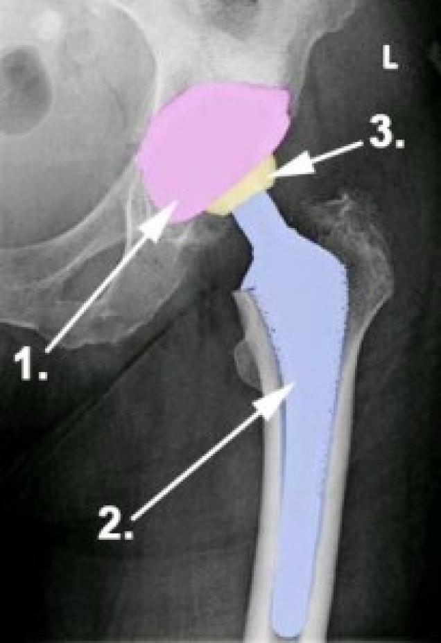 Die minimalinvasive Chirurgie bei Hüftoperationen bringt Vorteile