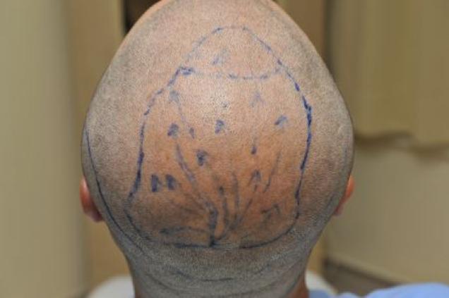 Techniken der Haartransplantation